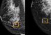 Google Health’s Artificial Intelligence better than radiologists at spotting breast cancer Breast Cancer