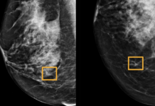 Google Health’s Artificial Intelligence better than radiologists at spotting breast cancer Breast Cancer
