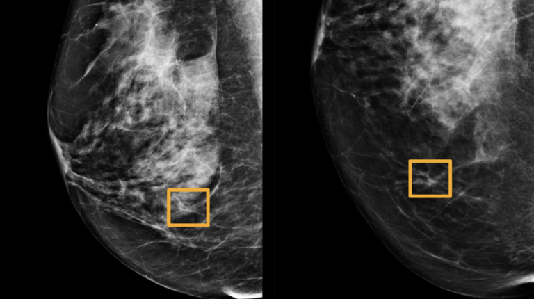 Google Health’s Artificial Intelligence better than radiologists at spotting breast cancer
