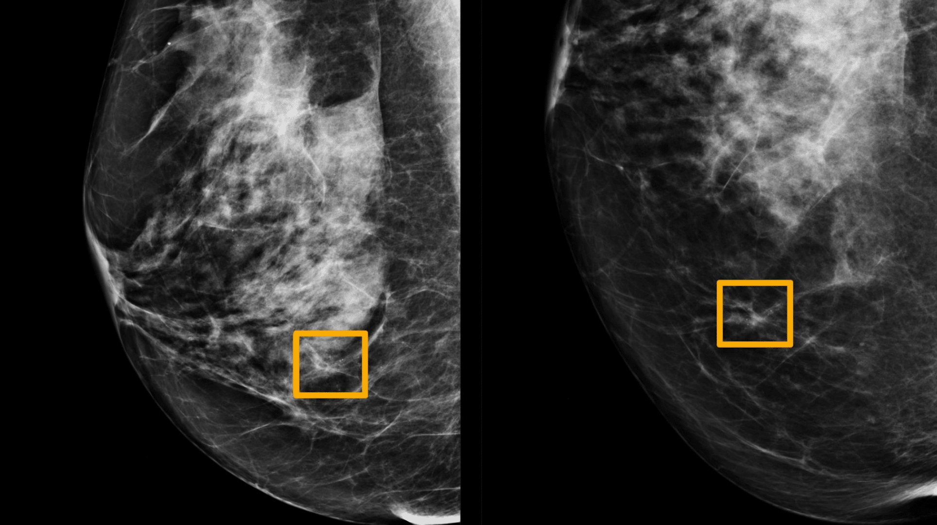 Google Health’s Artificial Intelligence better than radiologists at spotting breast cancer